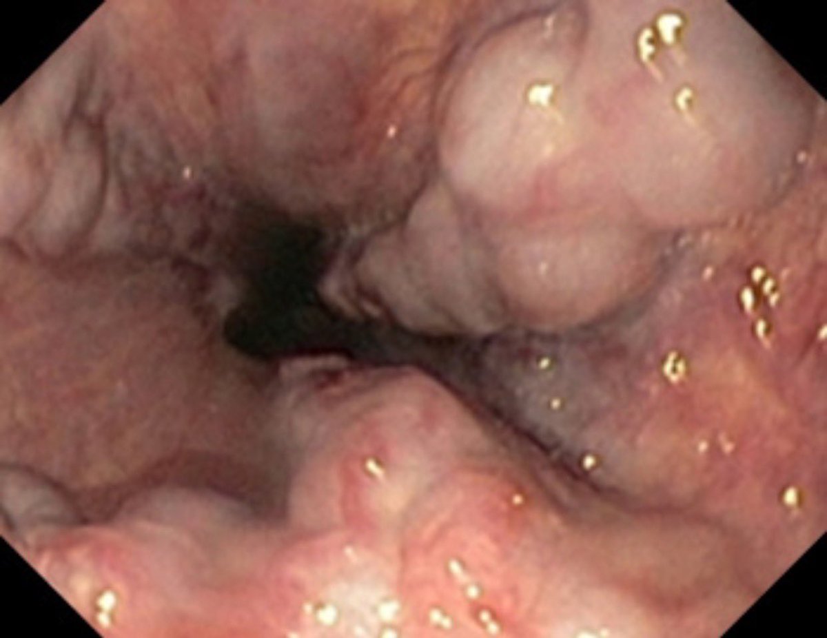 Endoscopic view of the esophagus.
What is your diagnosis?🤔🤔

#Usmle #DrSam👩🏼‍⚕️🩺 #medtwitter #match2024 #match2025 #ecfmg #ecfmgcertificate