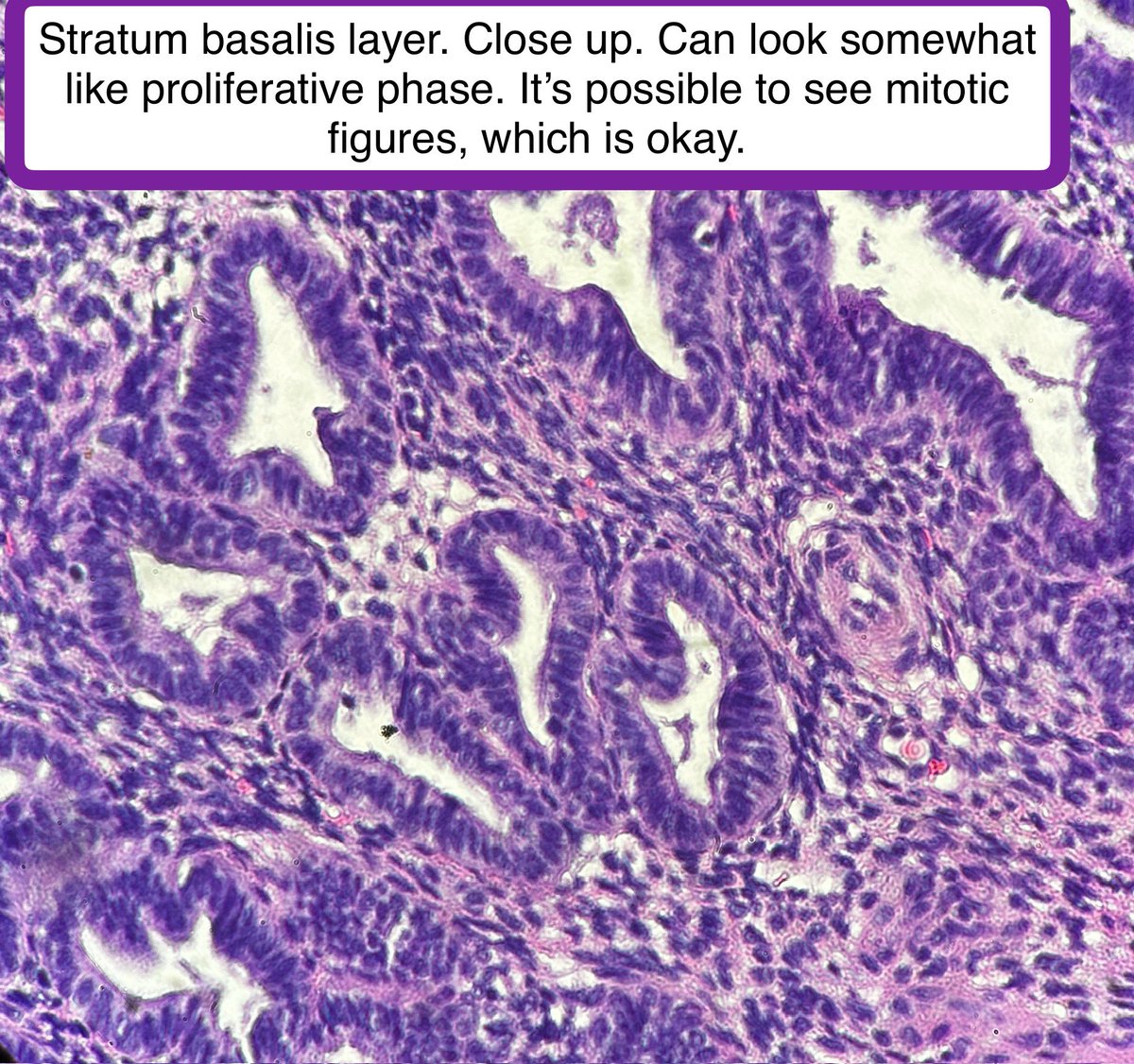Path4People's tweet photo. Stratum basalis regenerates the #endometrium after #menses
The stratum basalis can look different from the overlying endometrium and can have mitoses.
If damaged, this can lead to #Asherman Syndrome and difficulty with pregnancy
( 👇 are endometrial currettings for #fibroids) https://t.co/FFrJol3tou
