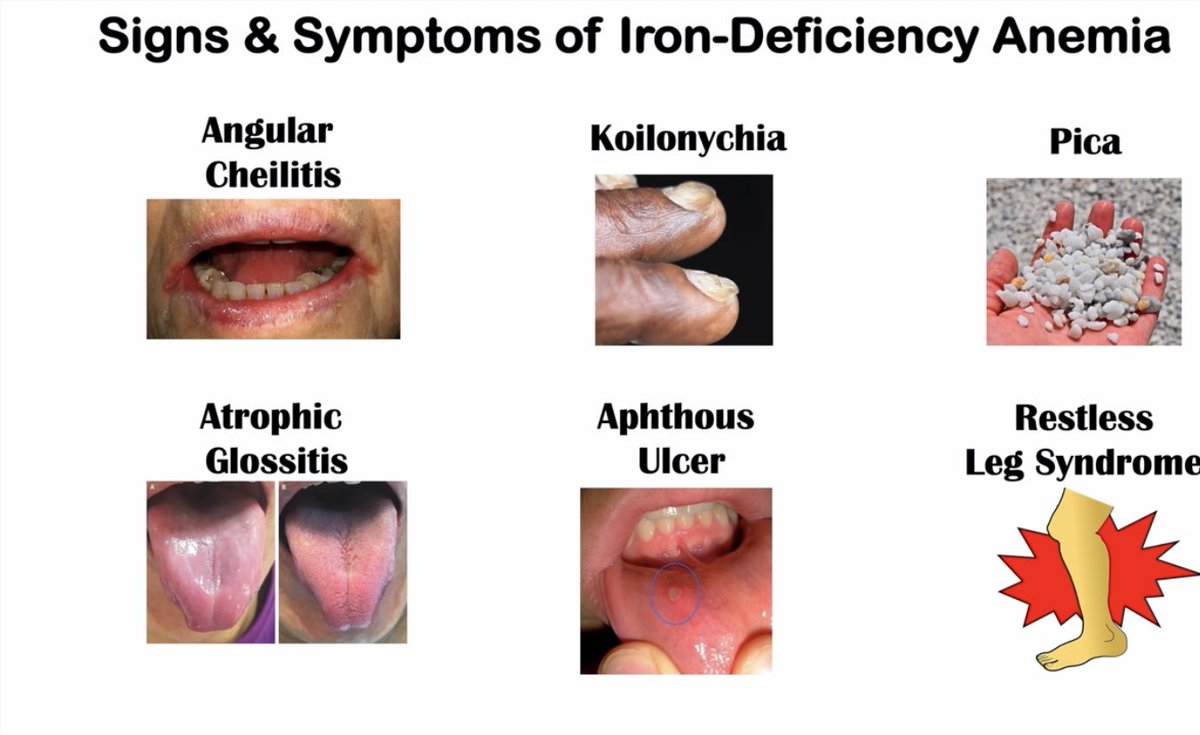 ملخص ال iron deficiency anemia ⭐️💡
