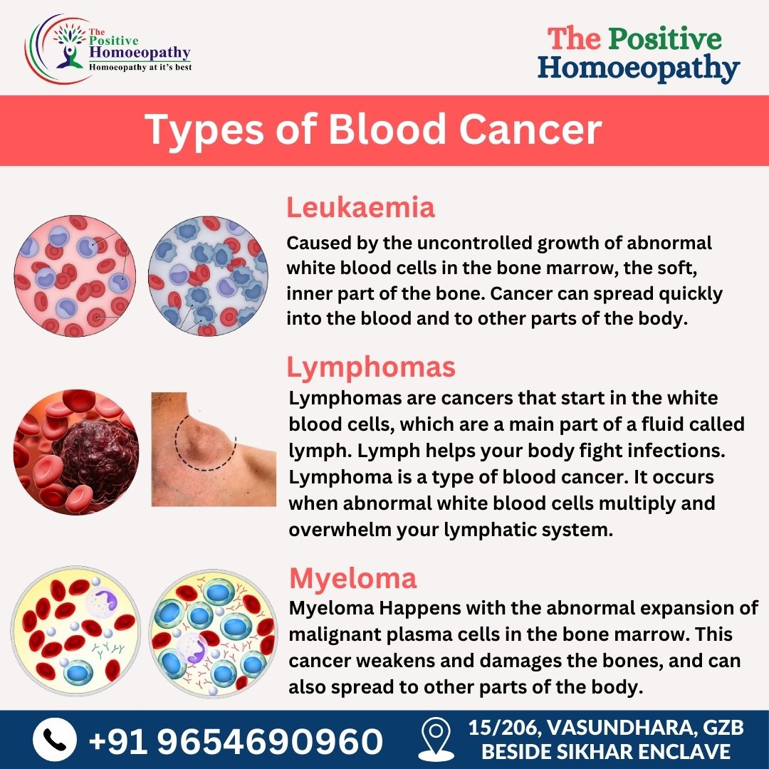 Types of Blood Cancer
Let's embrace wellness together.
 Book Appointment homoeopathy clinic near me:
 thepositivehomoeopathy.com
 Call Us: +91 9654690960
#BloodCancerAwareness #FightBloodCancer #Homoeopathy #NaturalHealing #homoeopathyHeals #EmpowerWithHomoeopathy
