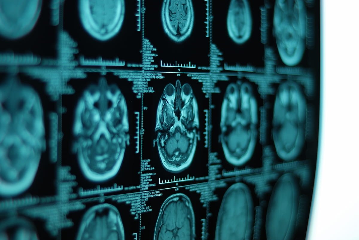 Study of Ofatumumab for #MultipleSclerosis Shows 'Profoundly Suppressed #MRI Lesion Activity' diagnosticimaging.com/view/ofatumuma…
@ACRRFS @ACRYPS @RadiologyACR @ARRS_Radiology @RSNA @RadiologyUSC @StanfordRad @UCSFimaging @OHSURadiology @MayoRadiology 
#radiology #neuroradiology #RadRes