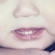 baby koo teeths 😢