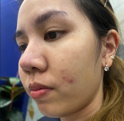 PJSahutsaya's tweet image. อยากจะบอกต่อแบบบอกต่อจริงๆ ตัวนี้กินเองแบบ100% บอกเลยว่ากินต่อเนื่องแล้วผิวดีมาก จากที่สิวอุดตันเยอะๆตอนนี้มีน้อยมากๆ หน้าเนียนขึ้น สิวอักเสบลดลง จากเดิมเป็นประจำเดือนทีก็บุกมาแบบตรึมอะ แต่พอกินตัวนี้เป็นประจำคือหน้าดีขึ้นจริงอันนี้ส่วนต้วนะ ให้เป็นเดอะเบสอะ #nectapharma…