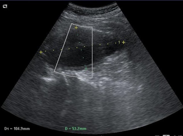 #Ecografia #AtenciónPrimaria 
Eco prostática con hallazgos que sugieren HBP con repercusión renal (hidronefrosis). De paso (no cuesta nada, somos MF) echamos un vistazo a la #aorta
El paciente vino por #nicturia y se fue con #HBP #hidronefrosis y #aneurisma aórtico abdominal AAA