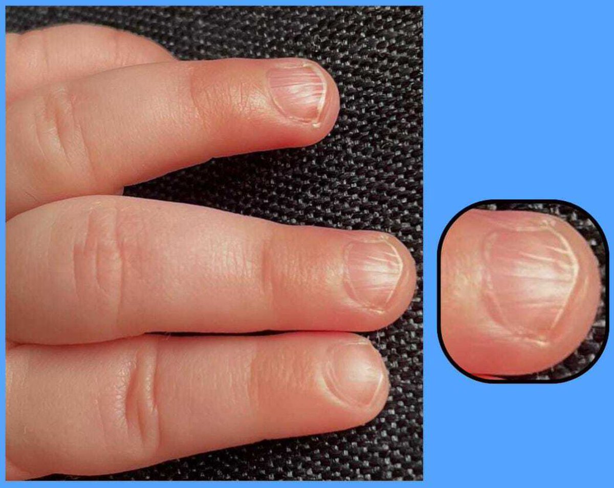 Images in paediatrics This is Chevron nail in a 6 month old Should you be worried? (Parental consent obtained) Read all about it adc.bmj.com/content/early/…