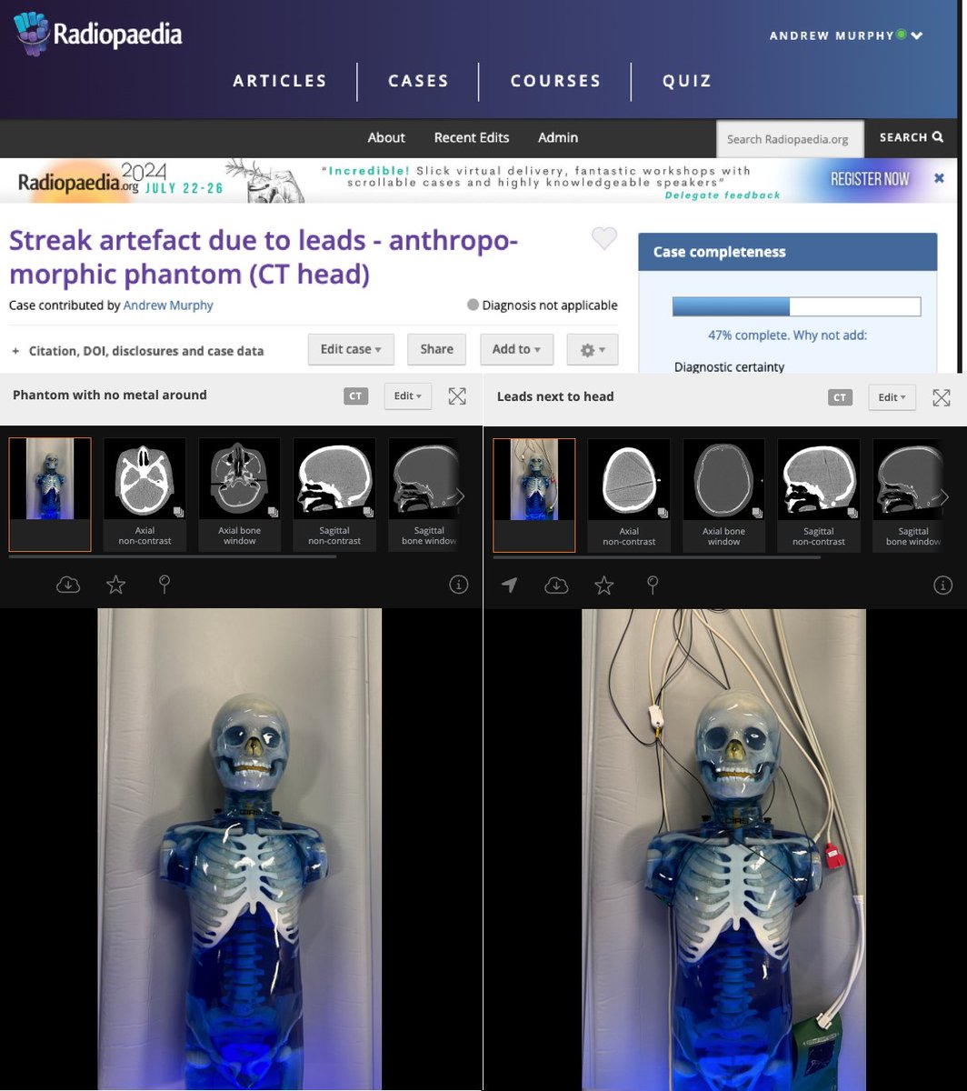 Ever wonder why we can't have anything near the head for a trauma scan? radiopaedia.org/cases/streak-a…