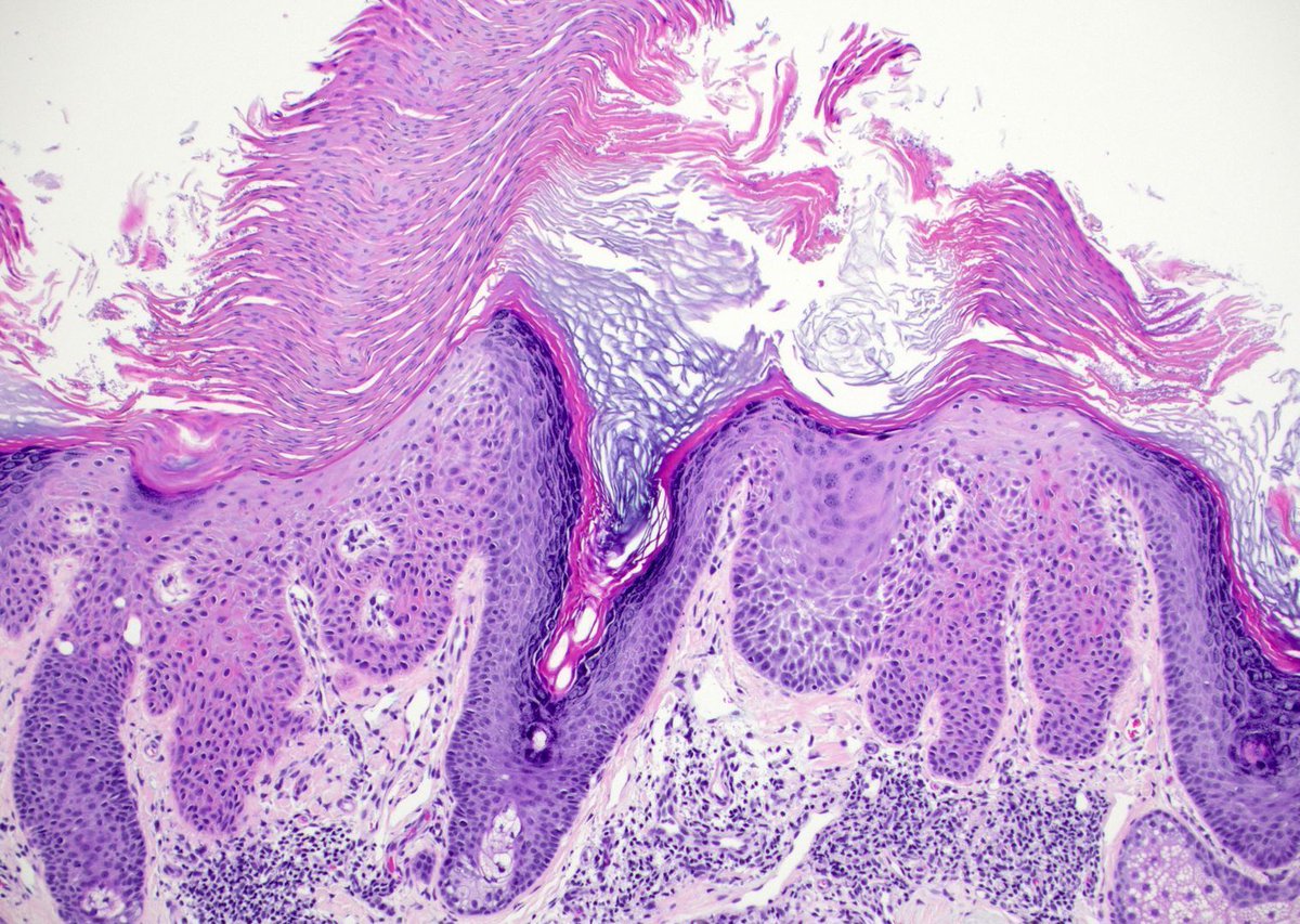 Thick scaly plaque on dorsal hand of 75 yo man. Your diagnosis? What 'sign' is demonstrated here? Answers (& more pics): kikoxp.com/posts/8940. Video explanation: kikoxp.com/posts/8826. #pathology #pathologists #pathTwitter #dermpath #dermatology #dermatologia #dermtwitter