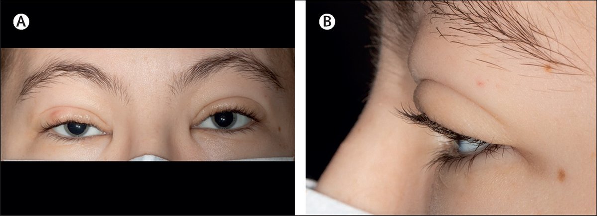 A 26-year-old woman with a 2-year history of swelling of her eyelids and reduced vision presented with: ➡️ Increased myopia ➡️ Decreased visual acuity ➡️ Scattered pale dots of the maculae ➡️ Suspected angioedema Find out what's going on: hubs.li/Q02tsCx50 #TLClinicalPic