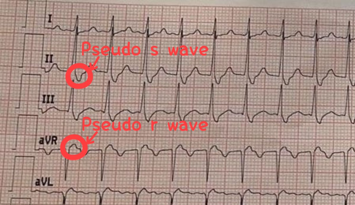 @EF_Cardiaca @smexcardiologia @residentesAMYTS @Sociedad_SEMI @ResidenteMI_HGM @ecgandrhythmRoe @ecgrhythms @ChuletasMedicas @SEMES_ @SEMERGEN_MIR @cardioteca NCT, HR 150bpm
➥Very short RP' tachycardia
➥s/o slow-fast AVNRT 
➥IV Adenosine💉💉💉 to see how to stop this NCT
➥EPS