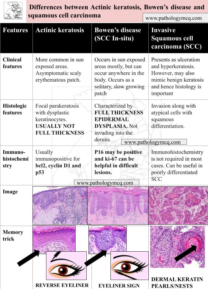 Differences between Actinic keratosis, Bowen’s disease and Invasive squamous cell carcinoma
#dmoncopathology #frcpath #frcpathpart1 #frcpathhistopathology #dermpath #instapath #pathologymcqs #pathologymcq #neetss #iniss #histopathology