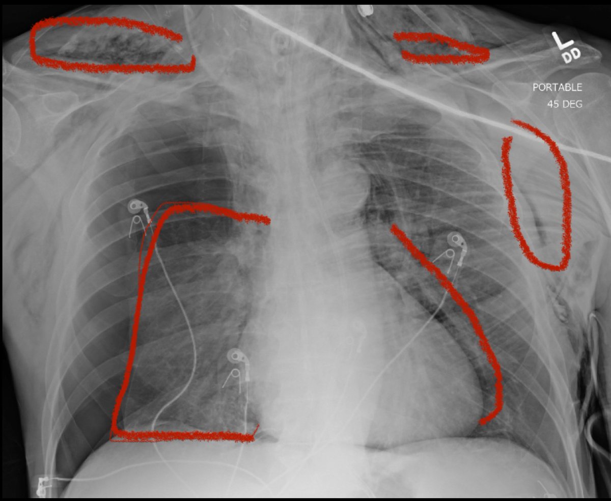 @EM_RESUS The most prominent findings are: 
Rt. Pneumothorax 
SC emphysema 
air rim around heart!! 

It seems that pt diagnosed with ARDS for whatever reason and got positive ventilation pressure, and unfortunately ended up having this Cpx.