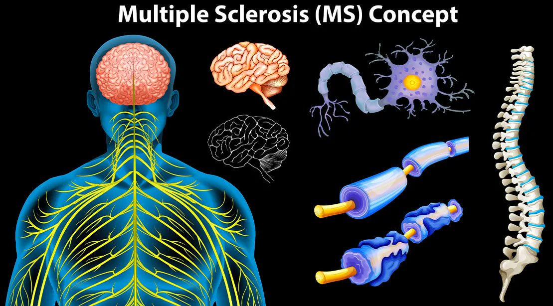 MS lesions on the #spine: What do you need to know?
#multiplesclerosis (MS) causes damage, called lesions, to parts of the #centralnervoussystem, including the #spine
#research
Learn more @ 2ly.link/1wyJv
#spineconference #spinehealth #spine #spinecare #neurosurgery