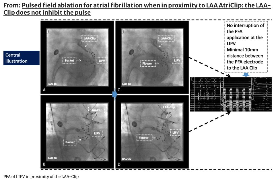 🚨New #FreeRead in @JICE_EP Pulsed Field Ablation for Atrial Fibrillation When in Proximity to LAA AtriClip: the LAA-Clip Does Not Inhibit the Pulse 📖🧐rdcu.be/dFlyN by Ramin Ebrahimi, @jongichun, @BorisSchmidt5 & @ShaojieChen1 #EPeeps