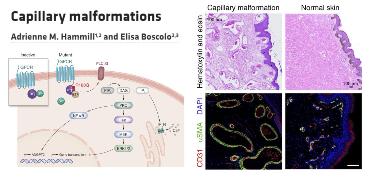 HaoYin20's tweet photo. Capillary malformations
A very nice reivew😋
GNAQ/Gαq activating variants
#somaticMutation VAF 1~33%
GNB2/Gβ
"CM vessels are characterized by multiple layers of pericytes"😍
Gαq-DREADD🐭
#SturgeWeberSyndrome #SWS @SturgeWeber
Not only skin lesion but also brain cortical calcification
"calcium deposits were mostly in the vessel wall of cortical capillaries and small venules"
MicroVascular Calcification!😎
Targeting mTOR/MEK/Gαq/CRAC channel
@BoscoloLab @jclinicalinvest 2024
https://t.co/GrlW5vwtMu