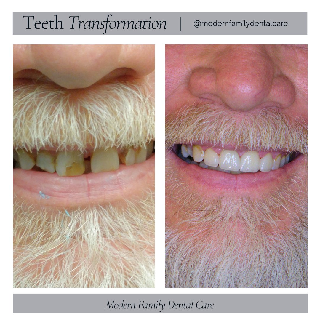 Just witnessed another incredible smile transformation at #ModernFamilyDentalCare 🌟 From battling gum disease to flaunting a vibrant, healthy smile 😁, our passionate care makes all the difference! #SmileMakeover #DentalHealth