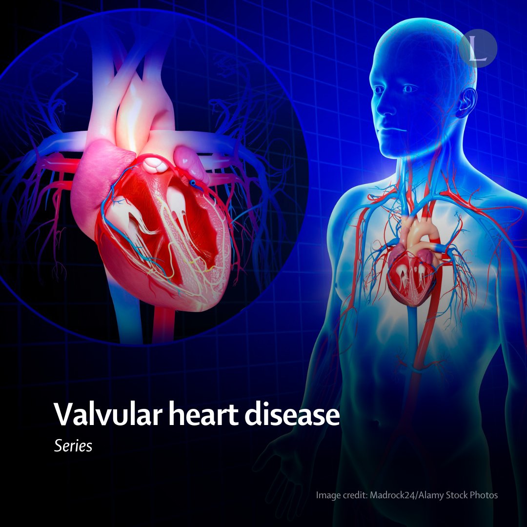 Valvular heart disease (VHD) is becoming more prevalent in an ageing population, leading to challenges in diagnosis & management. Explore a recent Lancet Series providing a comprehensive review of changing concepts in VHD & the current state of research: hubs.li/Q02trhzB0