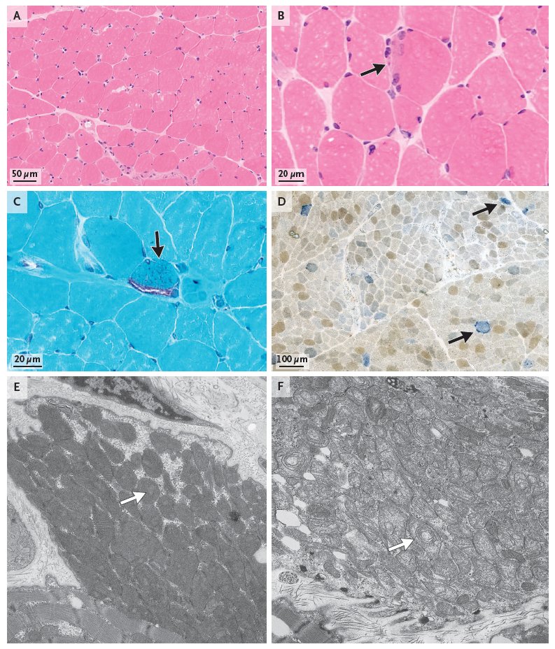 Case Records of the Massachusetts General Hospital: A 58-Year-Old Woman with Confusion, Aphasia, and Abnormal Head Imaging nej.md/49DGwrP