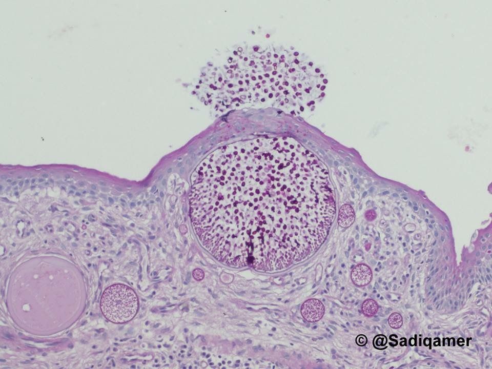 It's like a tiny infectious volcano! Your diagnosis? Answer & more pics here: kikoxp.com/posts/5703. Many thanks to @sadiqamer MD for these incredible images! #pathology #pathologists #pathTwitter #dermpath #dermatology #dermatologia #dermtwitter #ENTpath #microbiology