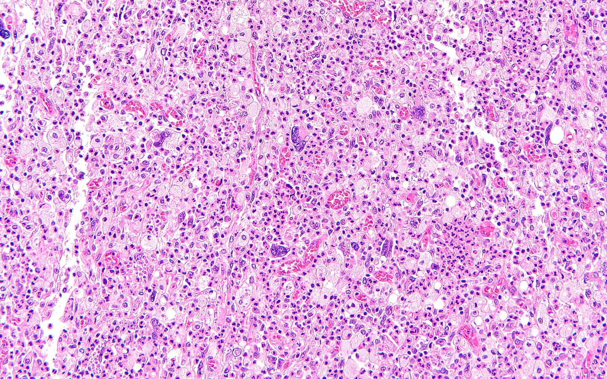 KyleDPerryMD's tweet photo. An (acute) obsession with inflammatory well-differentiated liposarcoma….
#BSTpath, #UmichPath, #BSTpathGoBlue