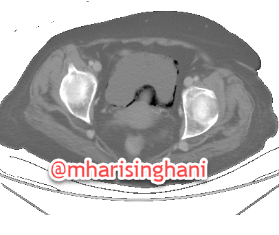 Emphysematous cystitis in a diabetic