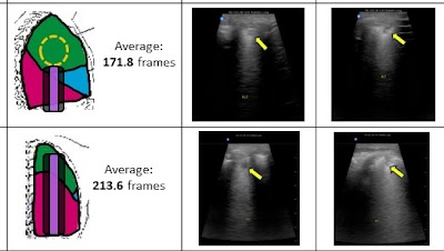 Lung ultrasound images from 200 Zambian children with pneumonia + 200 age- and sex-matched healthy children doi.org/10.1148/ryai.2… @BUSPH @ULTRaTrento @MCG_AUG #USRad #DeepLearning #AI