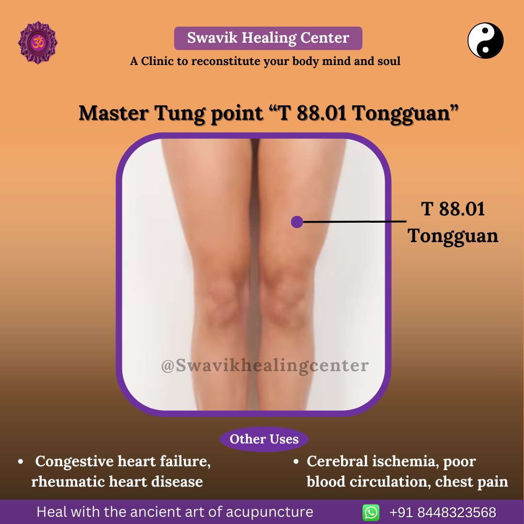 ☯ Master Tung point “T 88.01 Tongguan”
 
#acupunctureclinic #acupressurepoints #cuppingmassage #gurugramdiaries #congestiveheartfailure #congestion #rheumatic #cerebral #poorbloodcirculation #bloodcirculation #bloodflow #chestpain #cuppingmassagetherapy