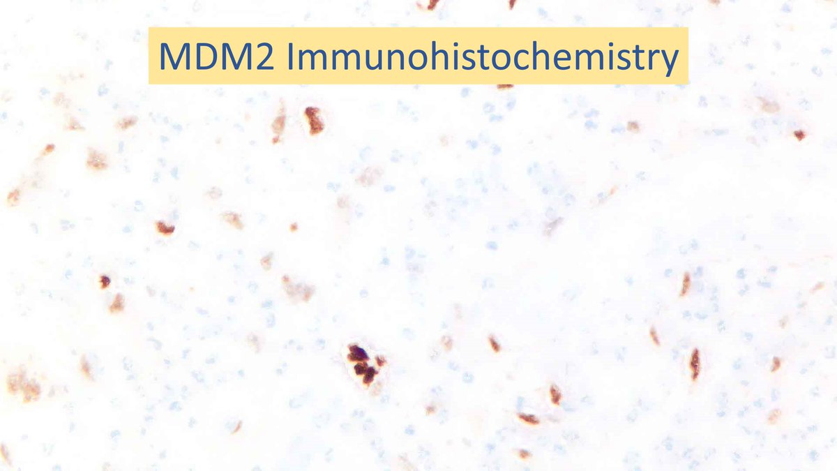 Tumor cells are positive for MDM2 by immunohistochemistry (and exhibited MDM2 gene amplification by FISH).