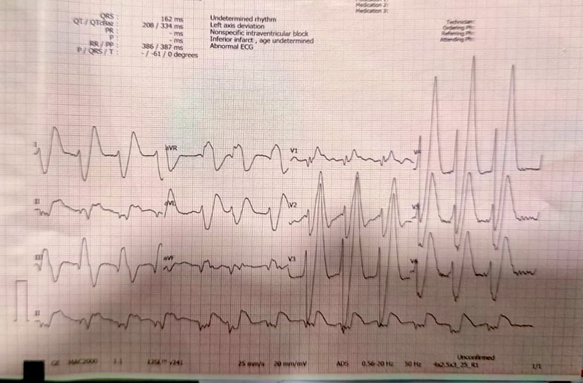 Here is a fascinating EKG of a 70 years male who was gasping and was intubated I! What’s your take?#CardioTwitter #ECG #FOAMed  @EM_RESUS @amalmattu @smithECGBlog @DrRazi4 @EcgOxford @EcgsOnly @ecgandrhythmRoe @The_Nanashi_O @PendellM @emcrit @FaheemYounus