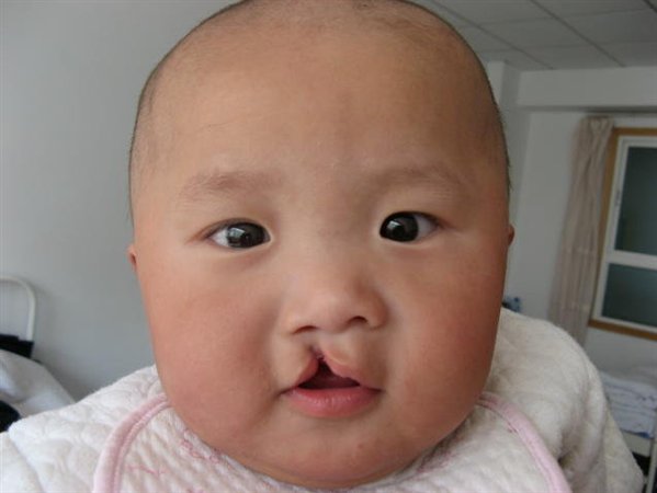 Cleft Lip and Palate Deformity
Full Story: rggnews.com/cleft-lip-and-…
#rggnews
#deformity #cleftlip