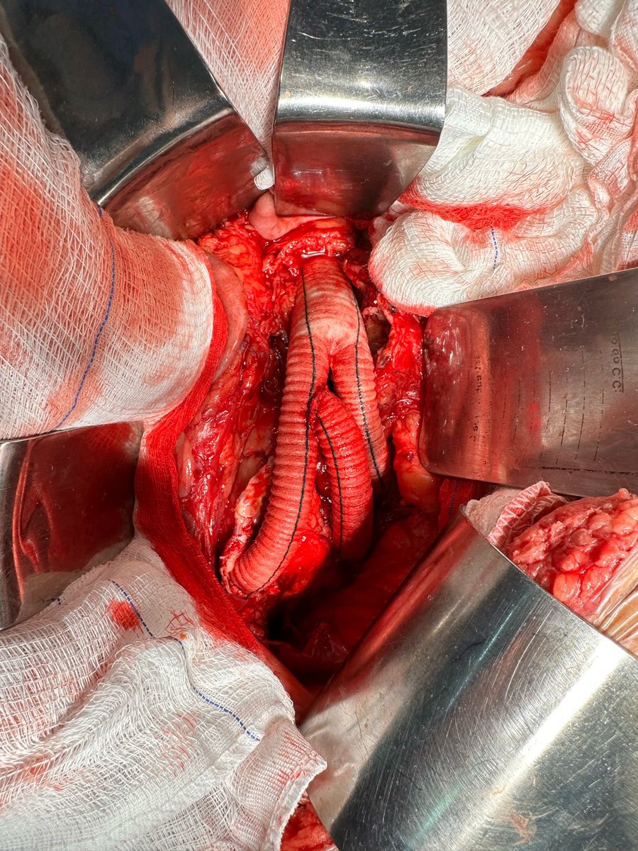 Very rewarding to quickly complete a complex aortic aneurysm with involvement of both hopogastric aneurysms! We must reimplant at least one of them!
#aortaEd