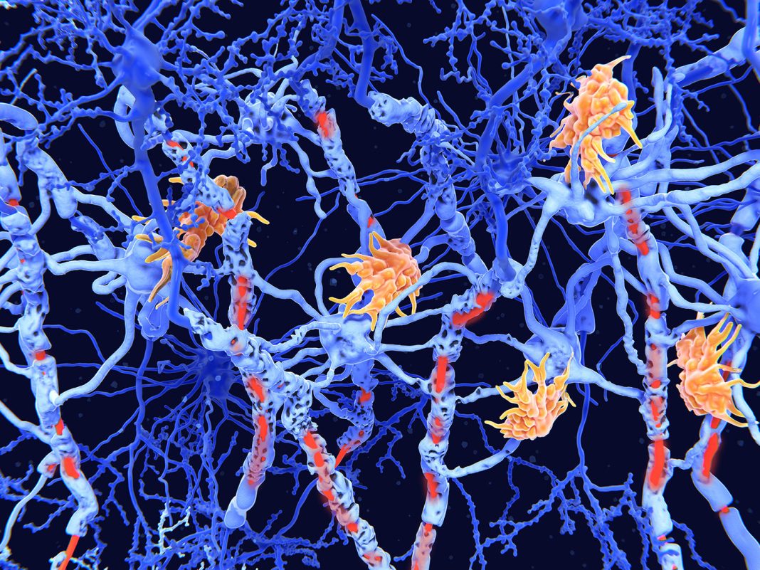 Blood Biomarker Reveals Signs of Multiple Sclerosis Years Before. Read more: ow.ly/K5pq50RjUZM