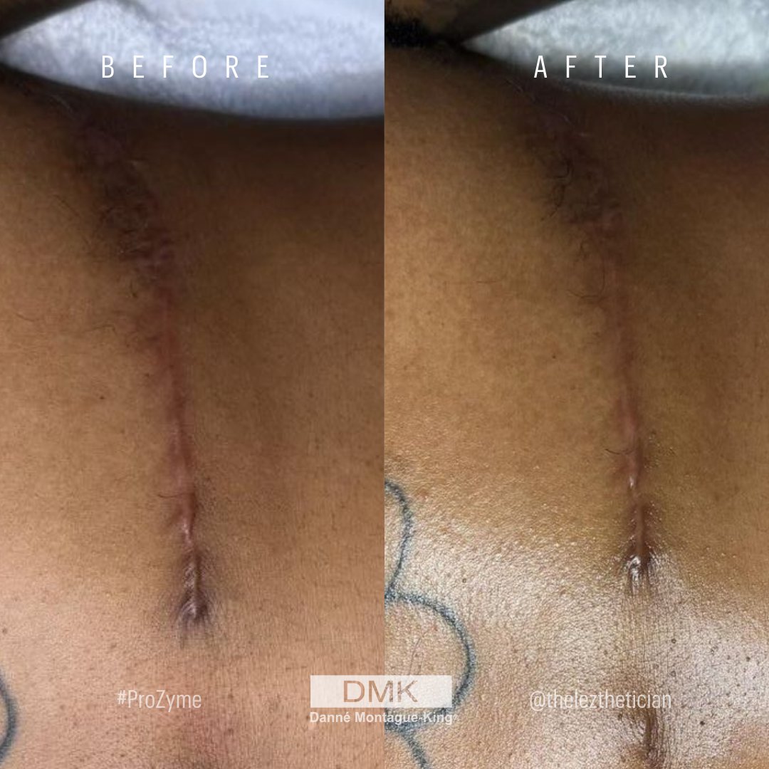 🔍 Quiz time Esthies!

How many custom sessions with DMK do you think it took to achieve this level of transformation? 🤔💬

A.) 1 Session
B.) 4 Sessions 
C.) 2 Sessions
D.) 5 Sessions

📸 @pansyesthetics 

#ScarRevision #TopSurgery #ScarCare #ifounddmk #DMKRevolution