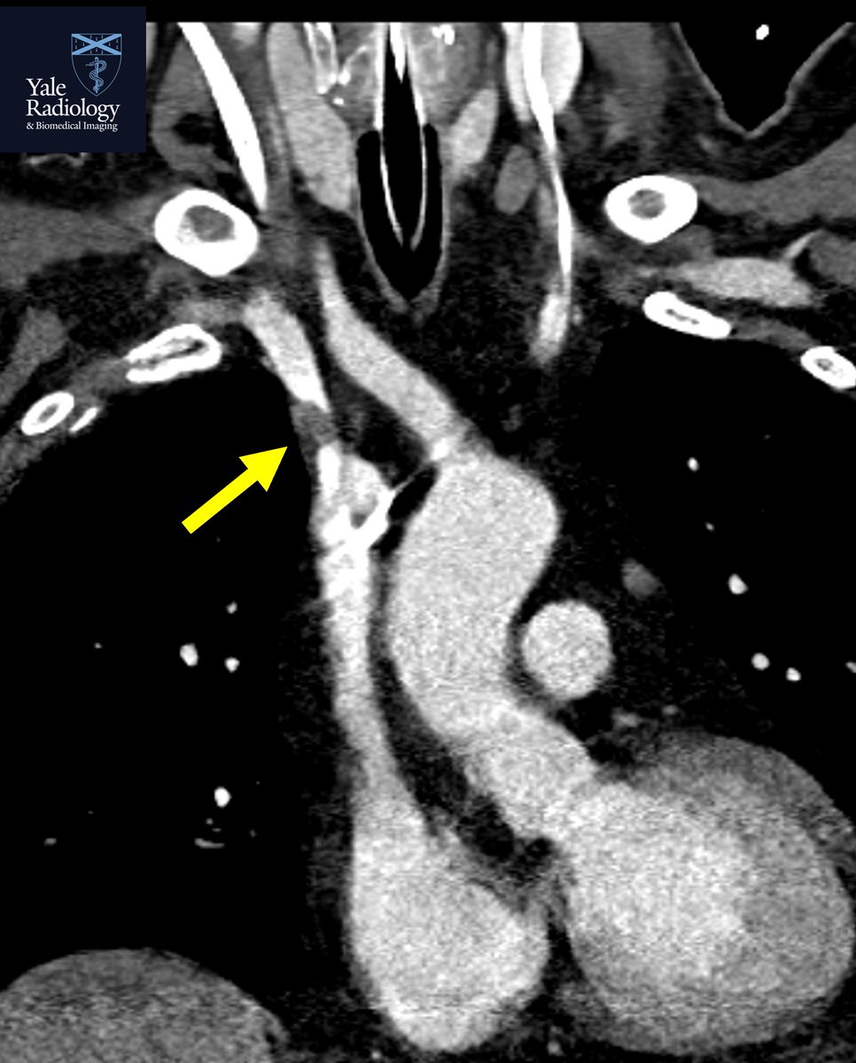 #MEDSTUDENTMONDAYS: subtle but real! Thrombus associated with a right sided central venous catheter! #yaleradedu #yaleradiology #MedStudentMondays #FOAMrad #FOAMed #radres @Mahan_Mathur @YaleRadiology #MedTwitter