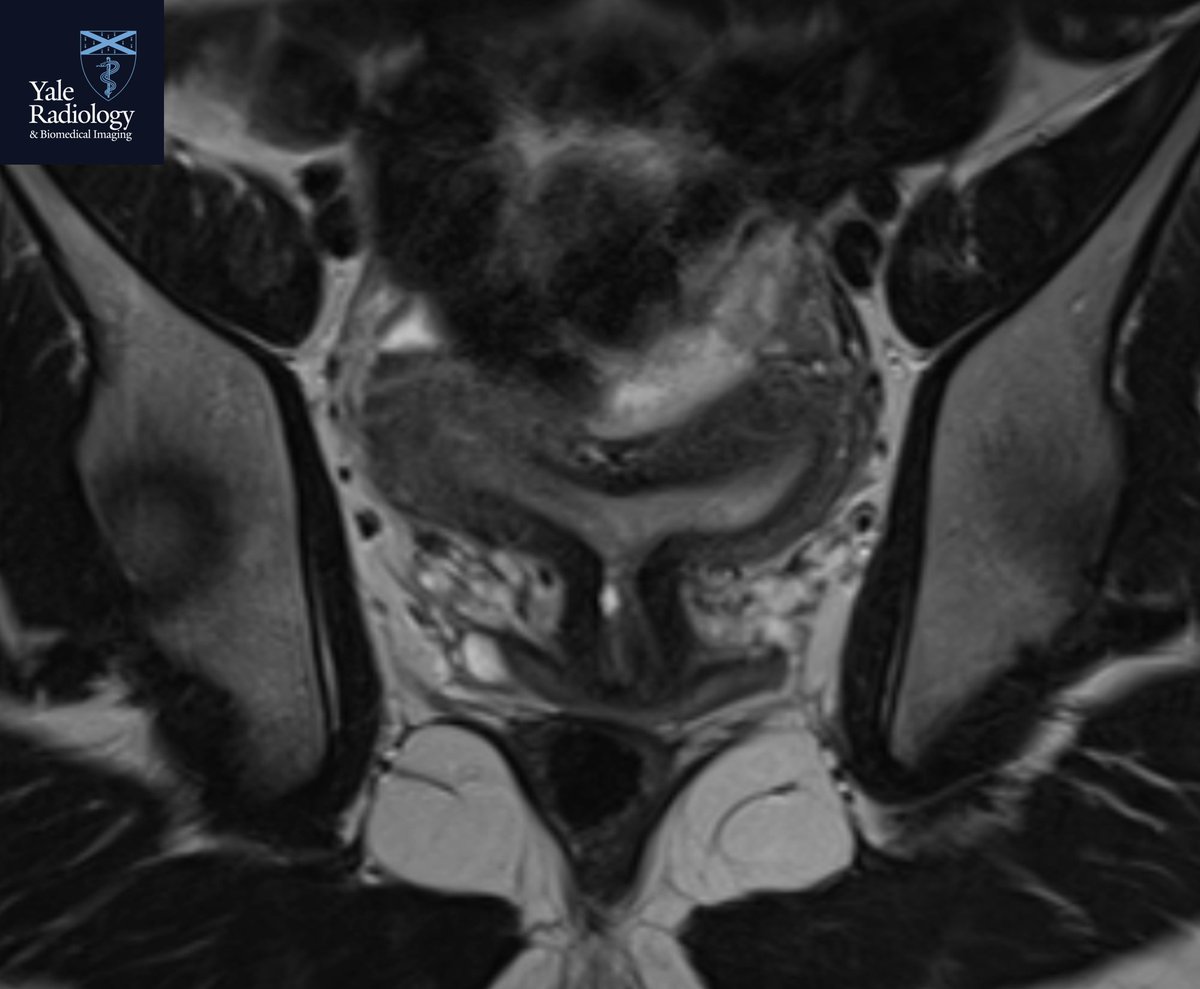 TEACHING COD: nice example of a bicornuate unicolliis uterus – two uterine horns with a deepened fundal cleft and a single cervical canal. #yaleradedu #yaleradiology #FOAMrad #FOAMed #radres #medstudent #radiology @Mahan_Mathur @YaleRadiology #MedTwitter