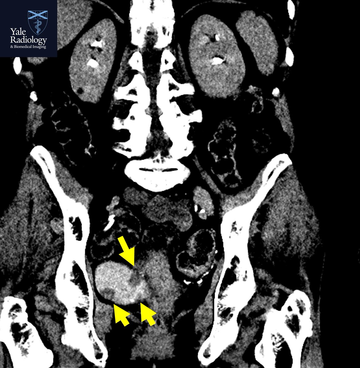TEACHING COD: despite the bladder not optimally filling with contrast, note the multifocal masses in this patient w/ hematuria #yaleradedu #yaleradiology #FOAMrad #FOAMed #radres #medstudent #radiology @Mahan_Mathur @YaleRadiology #MedTwitter