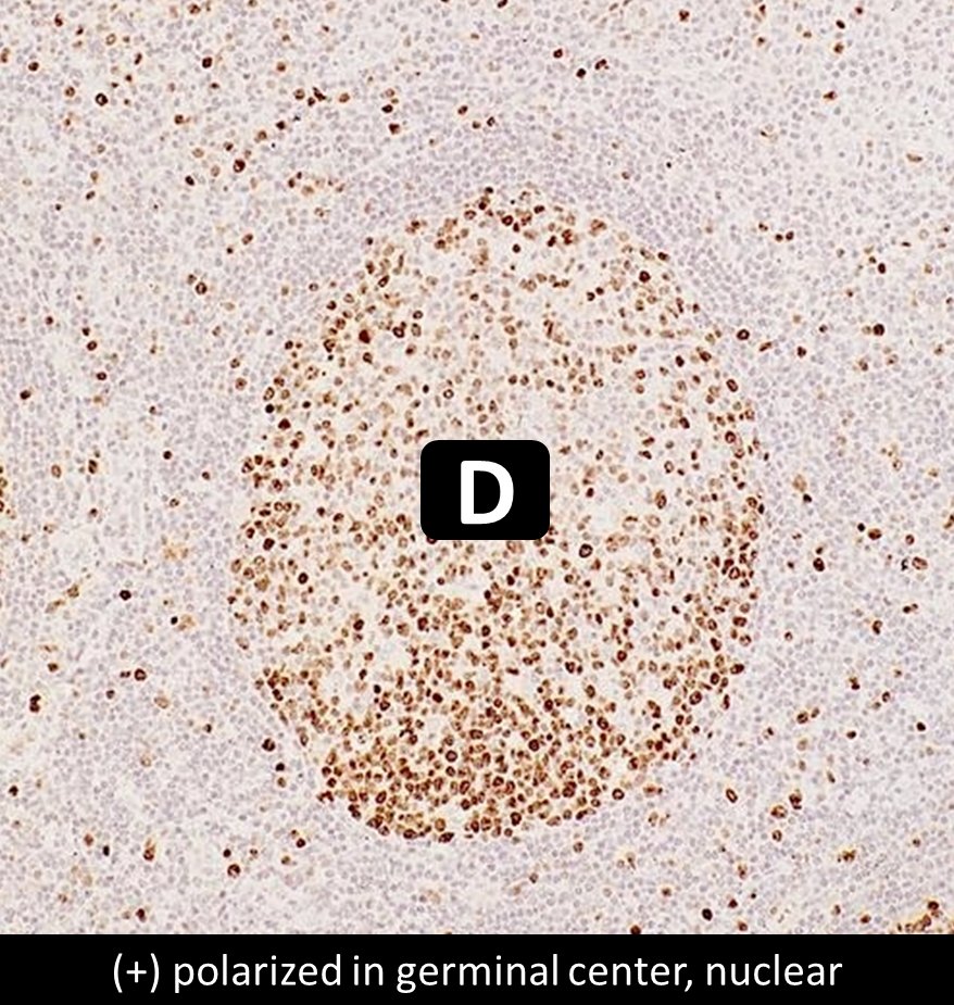 Which is CD10?
A) (+) GC, membranous
B) (-) GC, membranous
C) (+) GC, nuclear
D) (+) polarized in GC, nuclear
#HemePath #PathTwitter #pathology