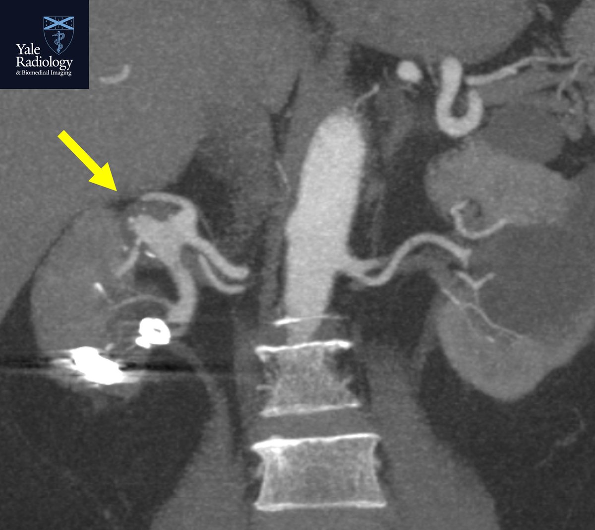 #MEDSTUDENTMONDAYS: 2-3 cm partially thrombosed right renal artery aneurysm nicely depicted on this CTA MIP image #yaleradedu #yaleradiology #MedStudentMondays #FOAMrad #FOAMed #radres @Mahan_Mathur @YaleRadiology #MedTwitter