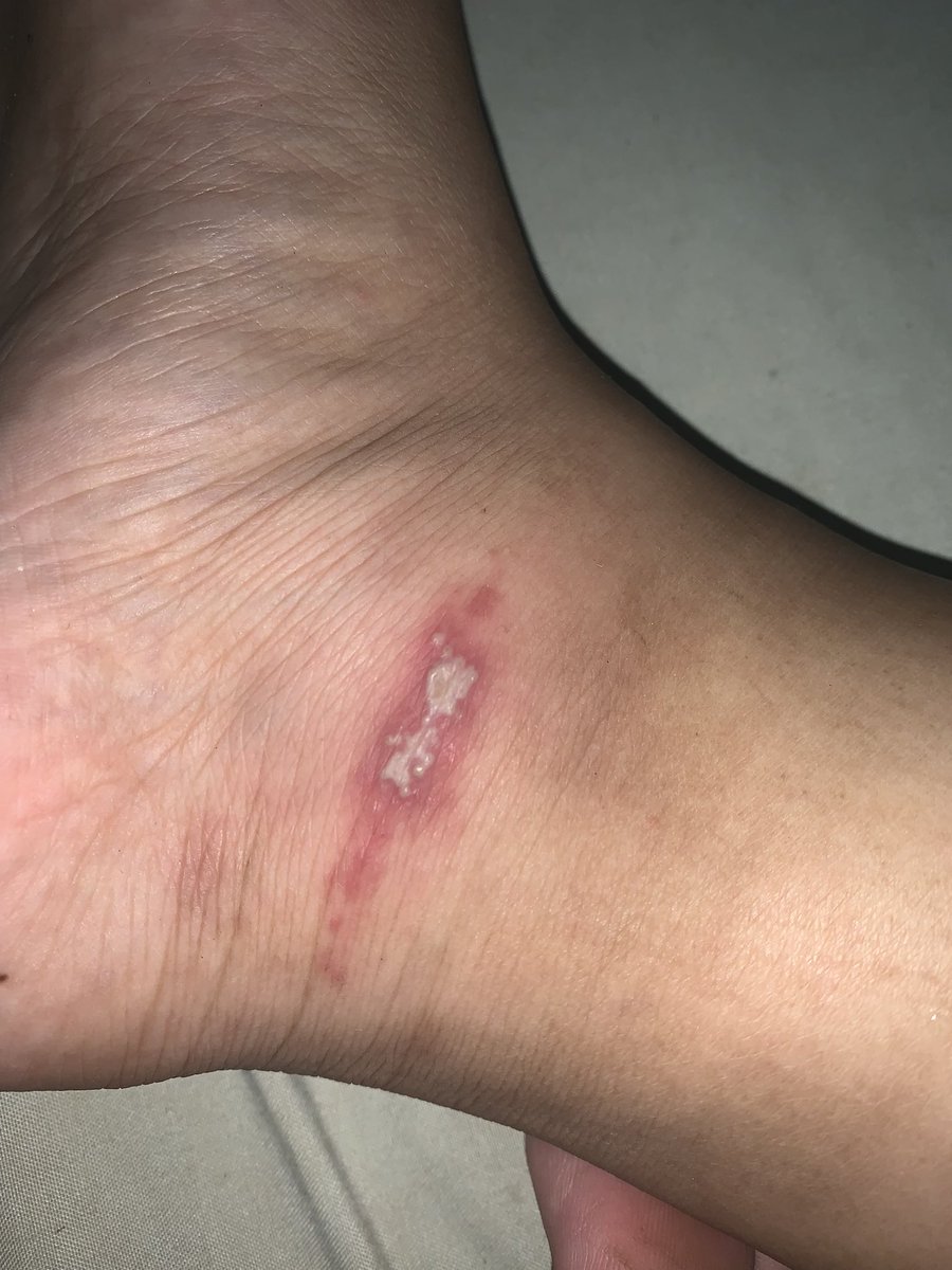 udah pake salep aciclovir

tetep masih sakit yaaa

mana gabisa langsung berdiri ,mesti pelan2, 😭😭

gmn caranya cepet kering yakk ????