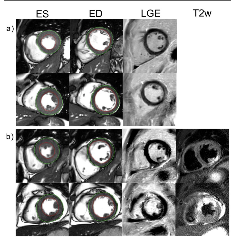 Anna Giulia Pavon (@annagiuliapavon) on Twitter photo 🚀 Do u know what Radiomics is?
‼️Texture analysis to extract and quantify patterns not straight forwardly detectable by human eye
🧲identify patients with AMI on #whyCMR bSSFP images!
👉 will LGE be useless in the future?🤨
👁️: link.springer.com/article/10.100…
<a href="/IJCVImaging/">International Journal of Cardiovascular Imaging</a> <a href="/SCMRorg/">Society for Cardiovascular Magnetic Resonance</a> 🚀 Do u know what Radiomics is?
‼️Texture analysis to extract and quantify patterns not straight forwardly detectable by human eye
🧲identify patients with AMI on #whyCMR bSSFP images!
👉 will LGE be useless in the future?🤨
👁️: link.springer.com/article/10.100…
<a href="/IJCVImaging/">International Journal of Cardiovascular Imaging</a> <a href="/SCMRorg/">Society for Cardiovascular Magnetic Resonance</a>