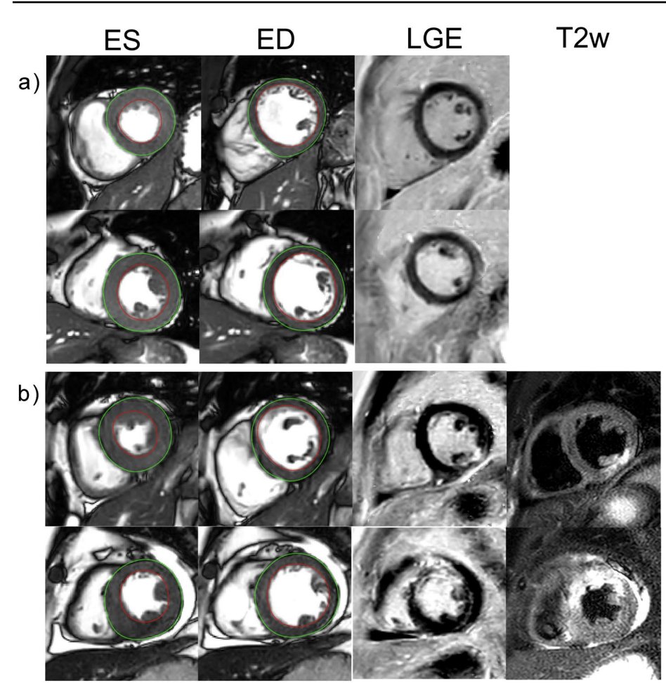 🚀 Do u know what Radiomics is?
‼️Texture analysis to extract and quantify patterns not straight forwardly detectable by human eye

🧲identify patients with AMI on #whyCMR bSSFP images!
👉 will LGE be useless in the future?🤨

👁️: link.springer.com/article/10.100…

@IJCVImaging @SCMRorg