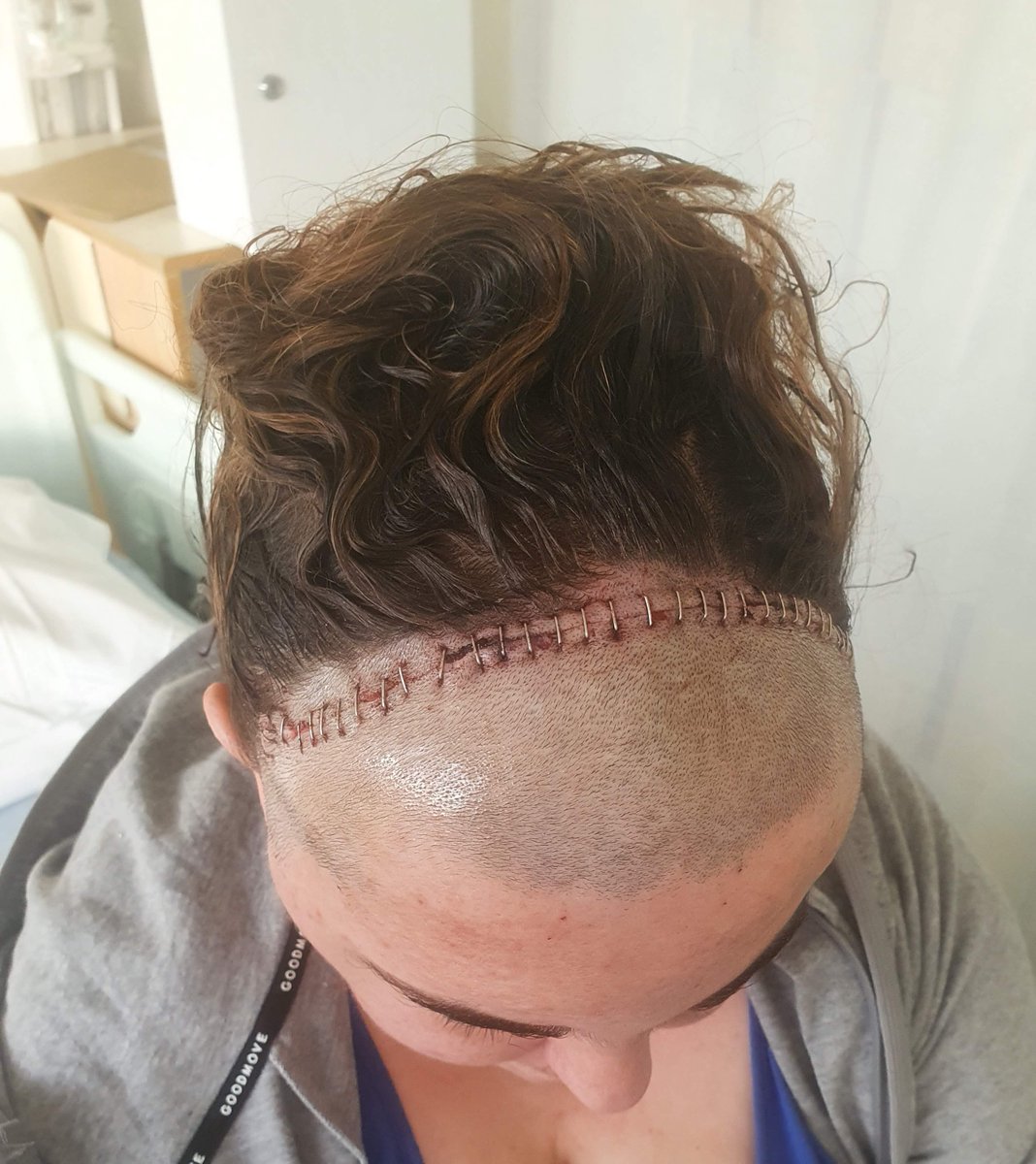 Brave Caroline Wrixon has shared her brain tumour story which began when she went for a routine eye test. She had no noticeable symptoms but her optician noticed an abnormality caused by a Grade 2 atypical meningioma tumour. Read about her journey here stgeorges.nhs.uk/newsitem/i-wen…