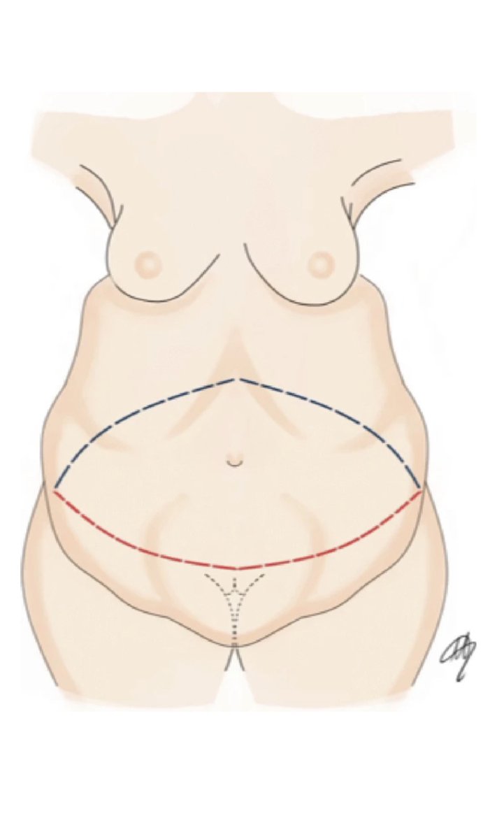 Extreme—Super obesity and panniculectomy: bipolar radiofrequency scalpel assisted surgery as a valuable option for the most challenging cases

OPEN ACCESS! From Italy 🇮🇹 

link.springer.com/article/10.100…
