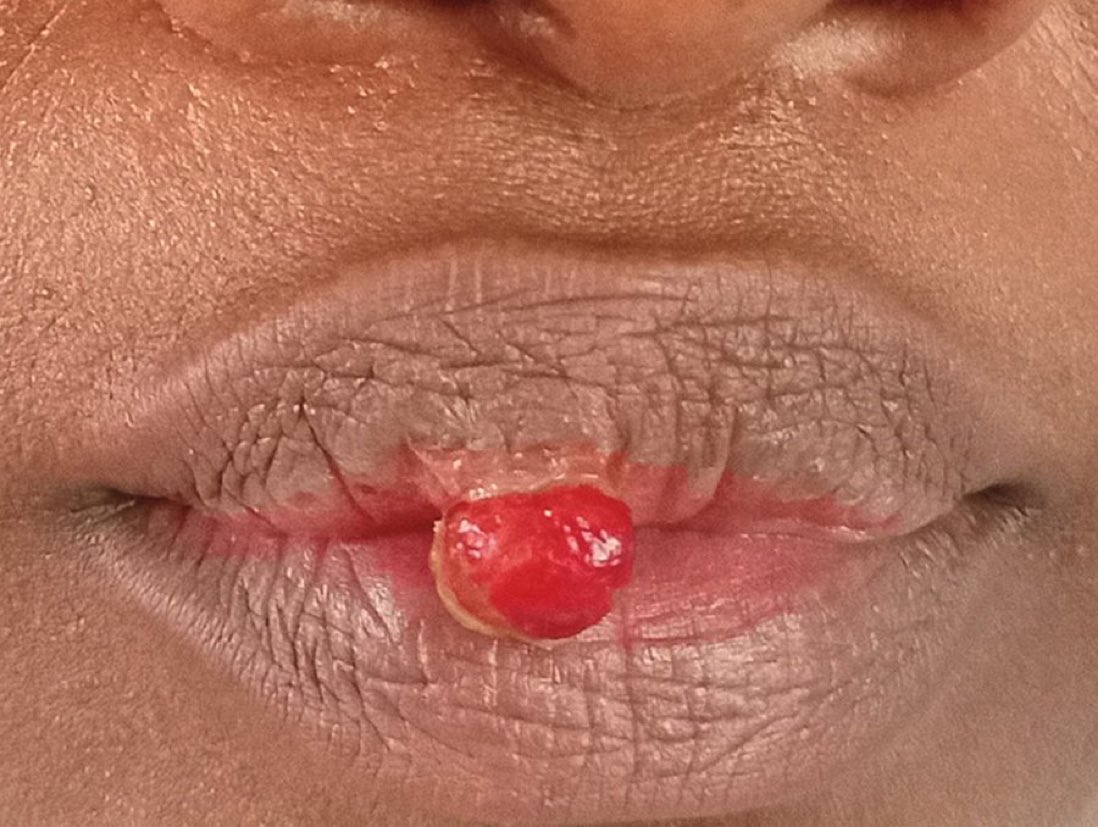 45-yo F w a 6 wk hx of lip lesion; increased in size over the prior 3 wks and bled when lightly touched. Examination showed an erythematous, round, smooth, pedunculated mass that was friable and non-tender. What is the most likely diagnosis? (Source: NEJM)