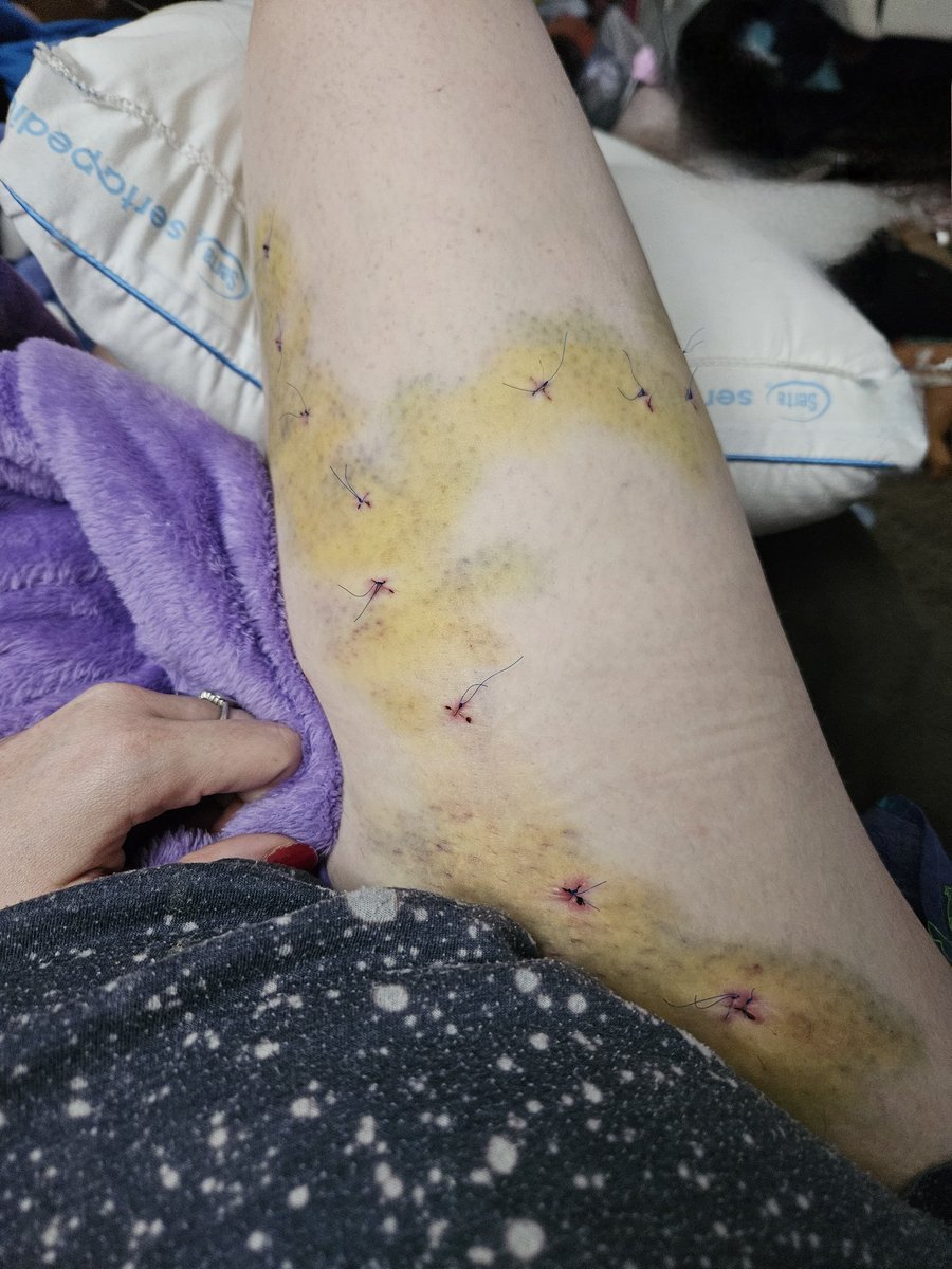 BEFORE and AFTER pictures!!  

This surgery truly has shown me who is there for me and isn't.  also is there for my family and isn't.  road to recovery ahead!!