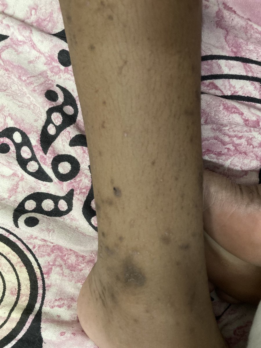 RadnuS81's tweet image. YO (10 Yrs) is having some skin allergy for the past 1 yr. Have consulted 4-5 Docs but it is not subsiding. It’s all over the body but more around his legs. Blood results normal. Anyone has noticed similar symptoms or rashes and got cured? Pls help. #TwitterHelp #MedTwitter