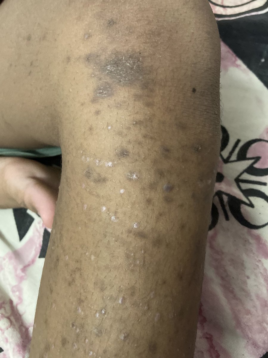 RadnuS81's tweet image. YO (10 Yrs) is having some skin allergy for the past 1 yr. Have consulted 4-5 Docs but it is not subsiding. It’s all over the body but more around his legs. Blood results normal. Anyone has noticed similar symptoms or rashes and got cured? Pls help. #TwitterHelp #MedTwitter