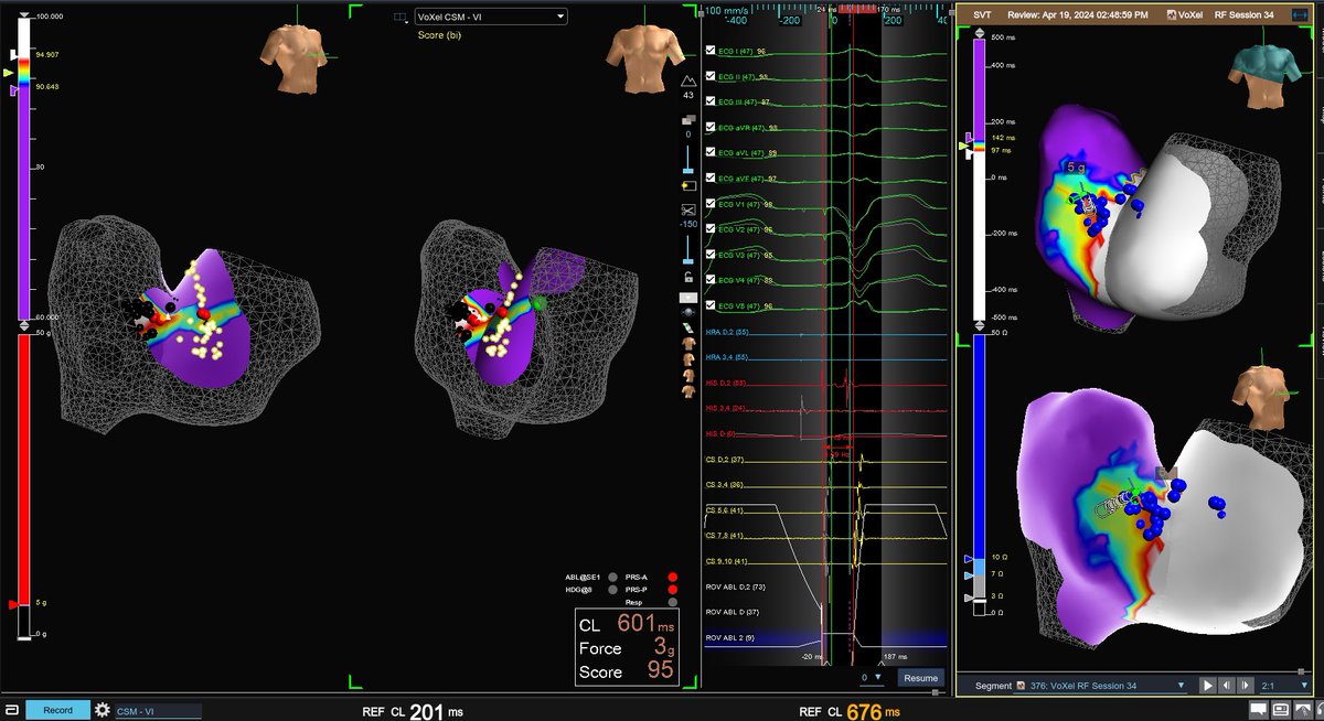 Remap of right free wall AP after initial lesions showed retrograde activation narrowed to a well defined channel. High power setting to overcome weaker contact with durable success. We stared at this some more. Amazing mapping @forkknifecab_EP #EPeeps