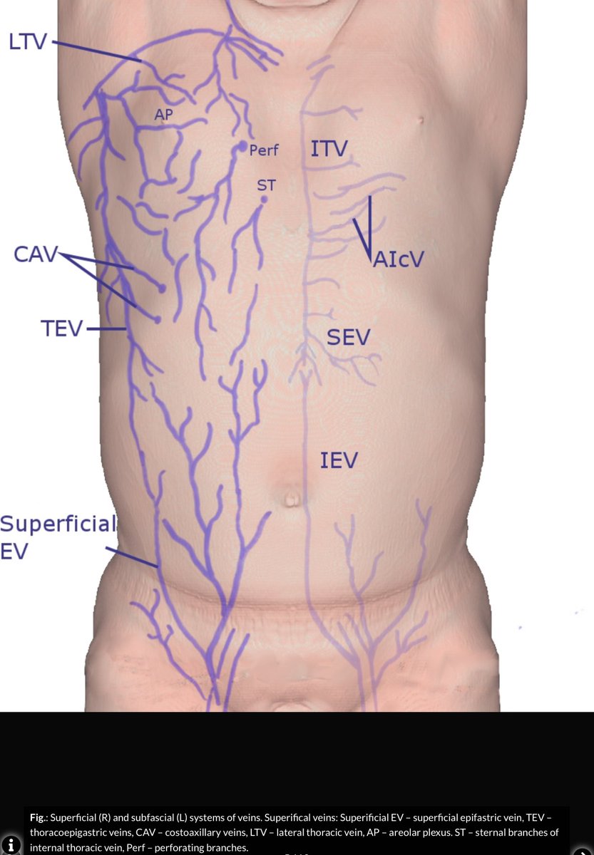 @rkalyes1 @DrOribaDan @TSM_Humanist @damshae87 @NiravValand30 @27Jipman @ps_lukwago @DMavine @DrAkhilRaghavan @DrOtileUg @drtamalehenry @Drwafulafrnco @graekan @GimonoMartha Was this the only visible vein or was this appreciated bilaterally? This could be the thoracoepigastric vein, a collateral which connects the femoral vein to the axilla that can be seen during IVC or SVC obstruction. Any features of this? epos.myesr.org/posterimage/es…