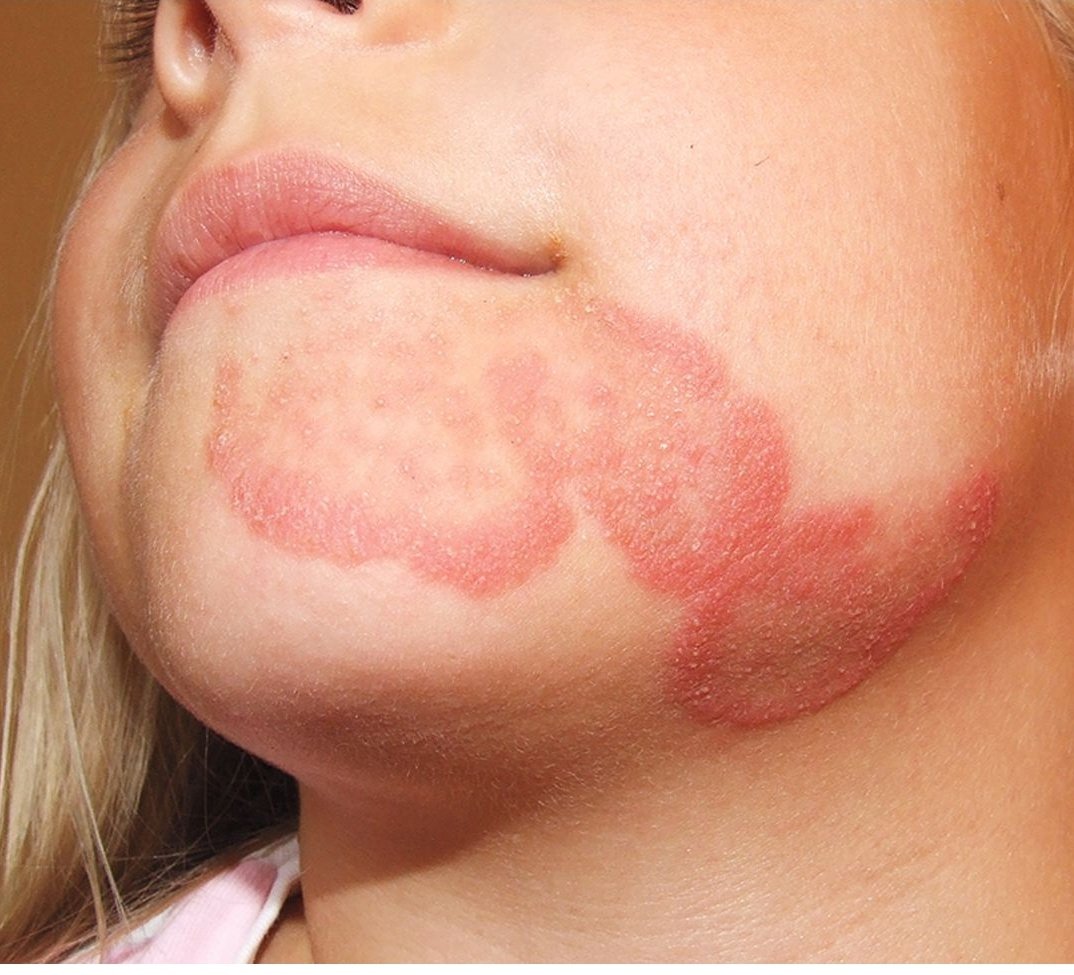 Q: A healthy 5-year-old girl presented with dry scaly erythematous annular lesions on her face. What is the diagnosis?
#MedTwitter #MedEd #Medical