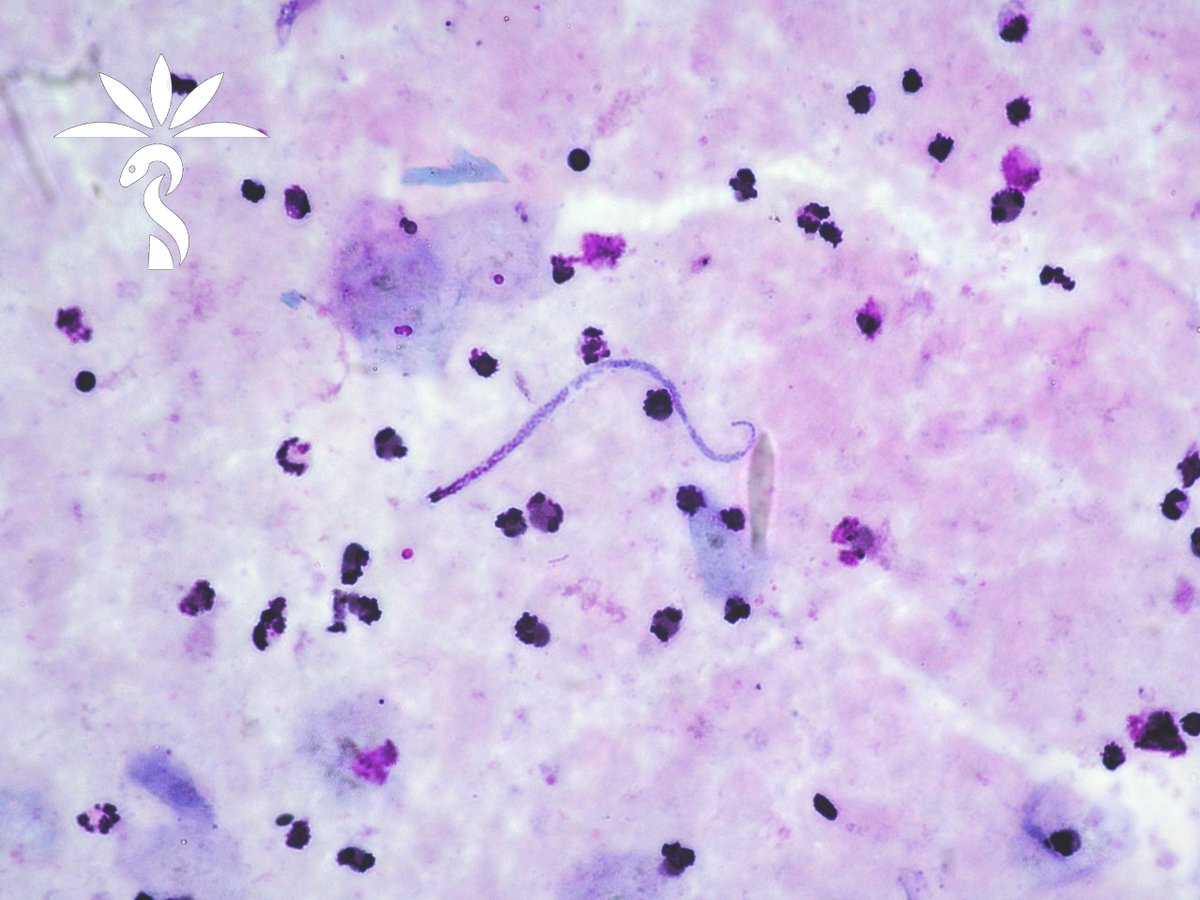 We are near the end of our fantastic microfilariae block from Idzi Potters and @ITMantwerp. The specimen is SKIN. The microfilariae are ~200 µm on Carazzi and Giemsa stained blood films. parasitewonders.blogspot.com/2024/04/case-o… Identification? #mayopath #pathology #CrittersOnTwitter #PathBugs